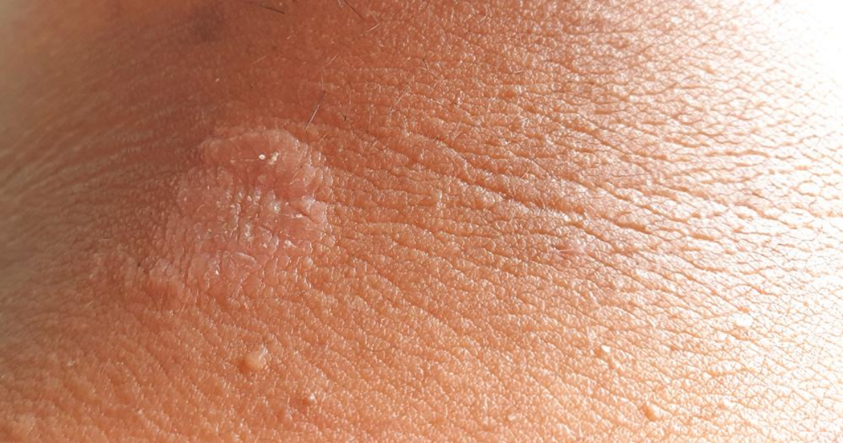 How to Treat Jock Itch?